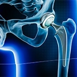 Modern Advances in Hip Replacement
