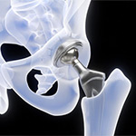 The Latest Innovations in Robotic-Assisted Hip and Knee Replacement Surgery
